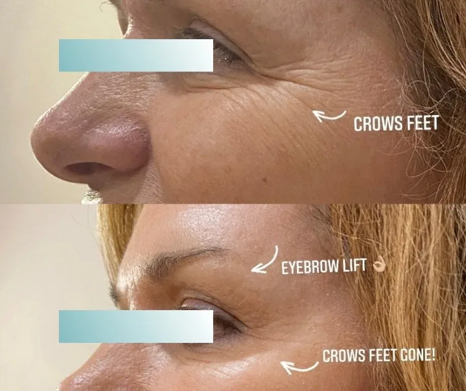 Before and after: crow's feet softened and eyebrow lifted