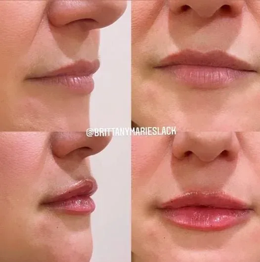 Before and after lip enhancement