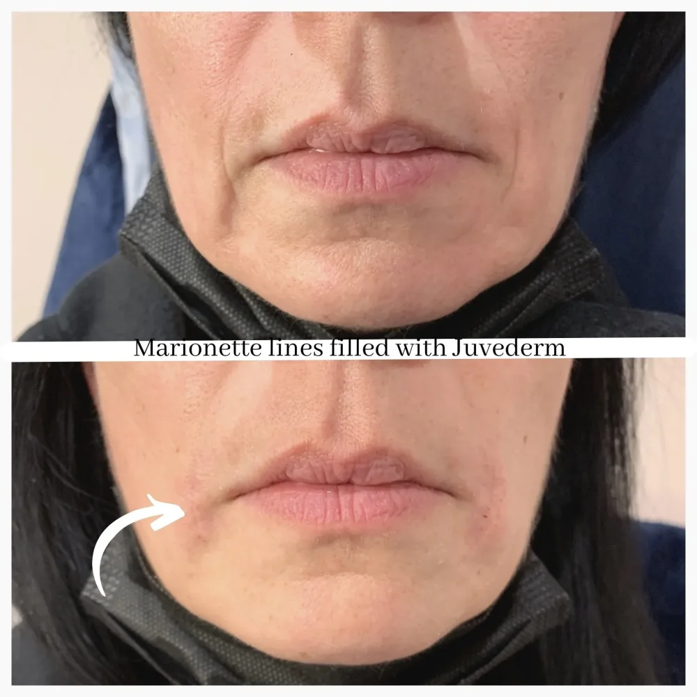 Before and after: marionette lines filled with Juvederm